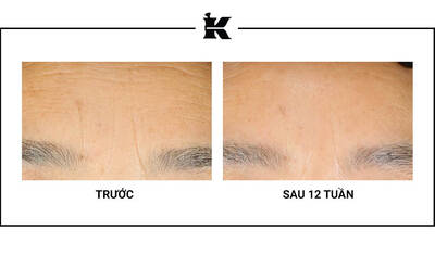 Before and After Retinol Serum