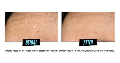 Before and After Glycolic Acid Serum