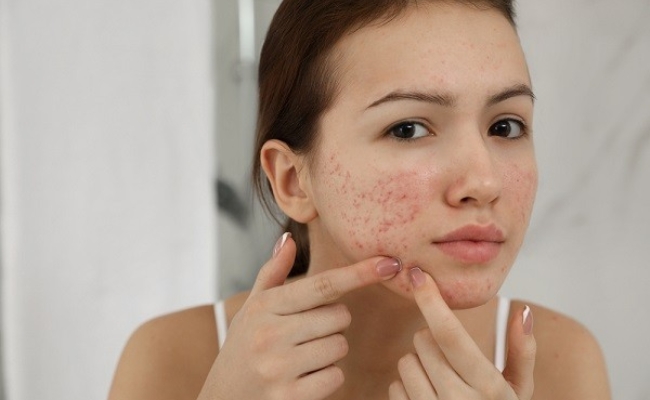 Niacinamide có trị mụn không?
