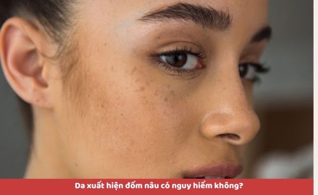 Da xuất hiện đốm nâu có nguy hiểm không?