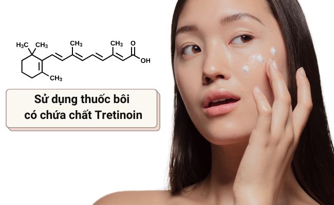 Sử dụng thuốc bôi có chứa chất Tretinoin