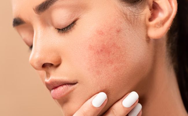 Xuất hiện phản ứng mạnh mẽ hơn da thường