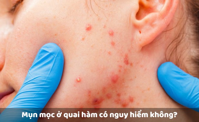 Mụn mọc ở quai hàm có nguy hiểm không?