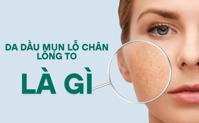 da dầu mụn lỗ chân lông to là gì