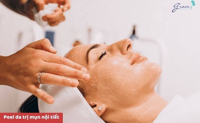 Cách điều trị mụn nội tiết hiệu quả
