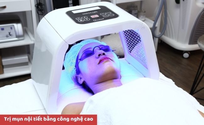 Cách điều trị mụn nội tiết hiệu quả
