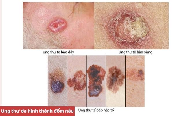 Nguyên nhân nổi đốm nâu