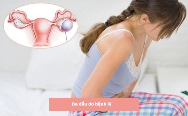 Nguyên nhân gây da dầu là gì?