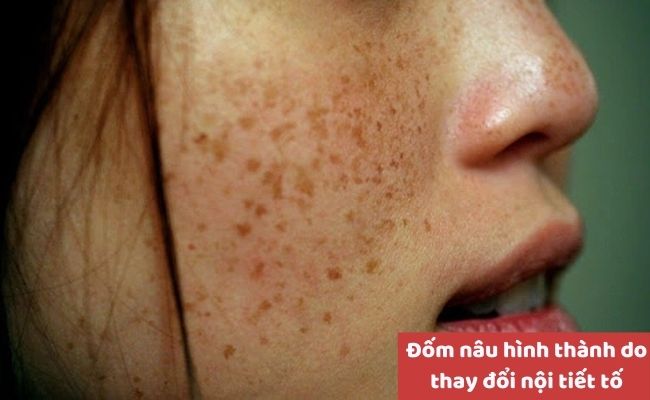 Nguyên nhân nổi đốm nâu