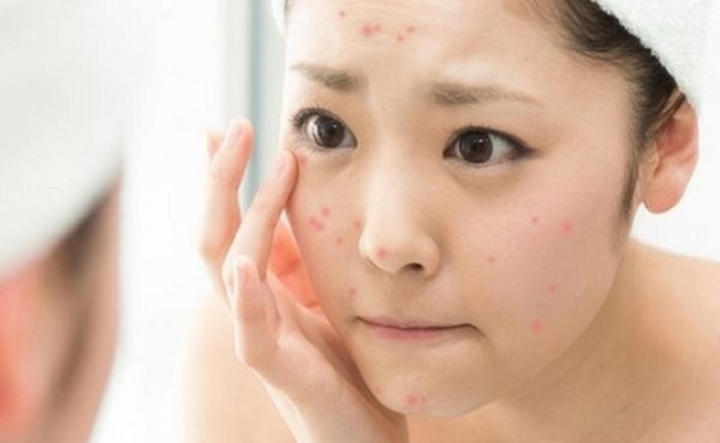 đặc điểm của làn da dầu mụn nhạy cảm