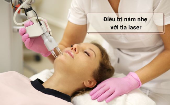 Điều trị nám nhẹ với tia laser