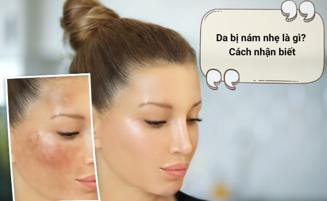 Da bị nám nhẹ là gì
