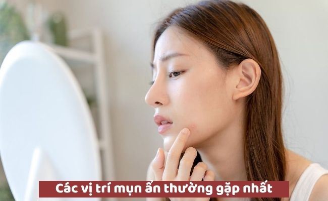 Các vị trí mụn ẩn thường gặp nhất