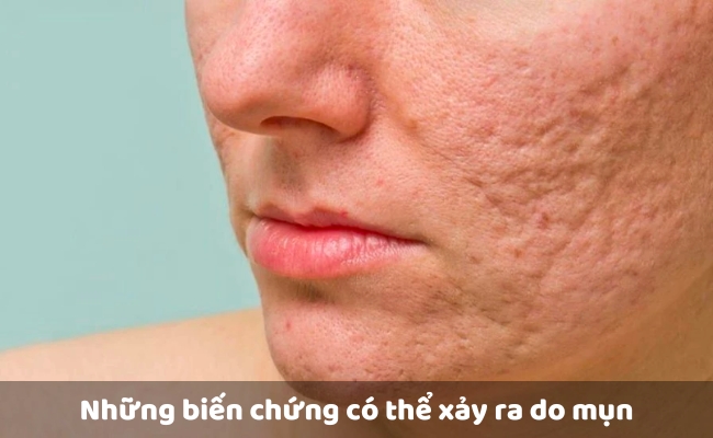 Những biến chứng có thể xảy ra do mụn