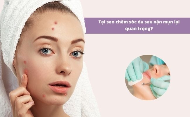 Tầm quan trọng của việc chăm sóc da sau khi nặn