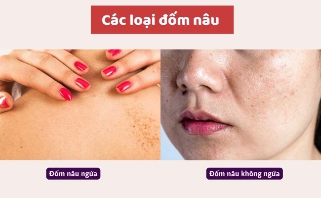 Các loại đốm nâu