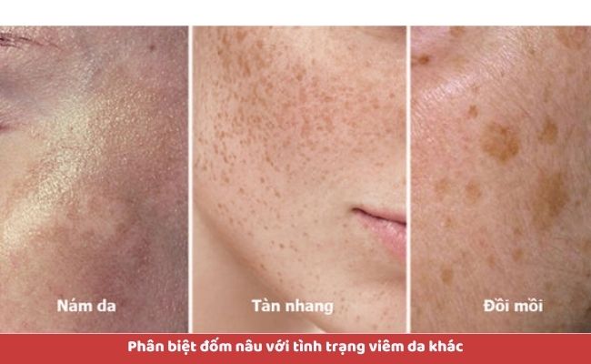Phân biệt đốm nâu với tình trạng viêm da khác