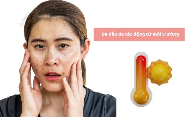 Nguyên nhân gây da dầu là gì?