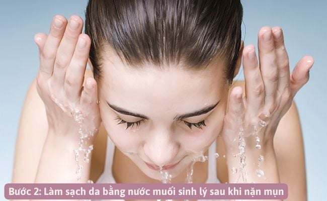 Mới nặn mụn xong nên làm gì để hết thâm sẹo?