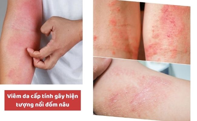 Nguyên nhân nổi đốm nâu