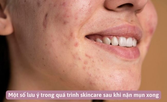Một số lưu ý trong quá trình skincare sau khi nặn mụn xong