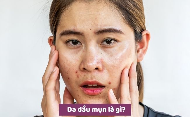 Da dầu mụn là gì?