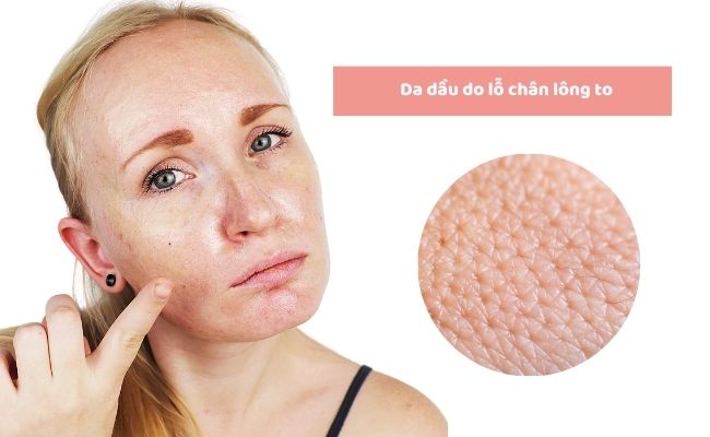 Nguyên nhân gây da dầu là gì?