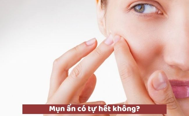 Mụn ẩn có tự hết không?