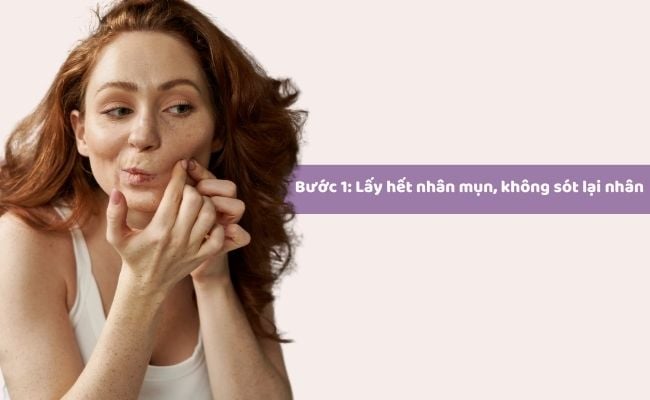 Mới nặn mụn xong nên làm gì để hết thâm sẹo?