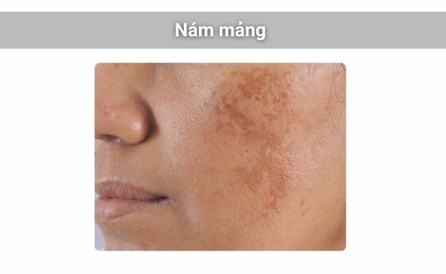 Mảng nám thường có màu nâu nhạt hoặc xám xanh, kích thước 2–4cm và dễ lan rộng