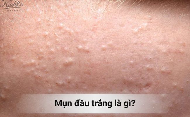Mụn đầu trắng là gì?