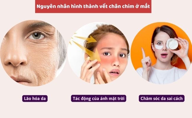 Nguyên nhân hình thành vết chân chim ở mắt
