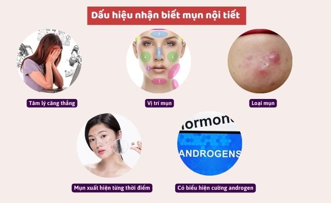 Dấu hiệu nhận biết mụn nội tiết
