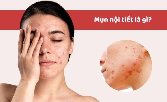 Mụn nội tiết là gì?