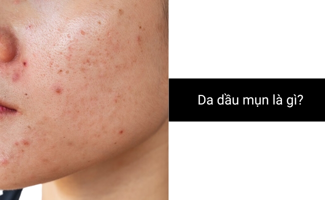 Da dầu mụn là gì? Đặc điểm của da dầu mụn
