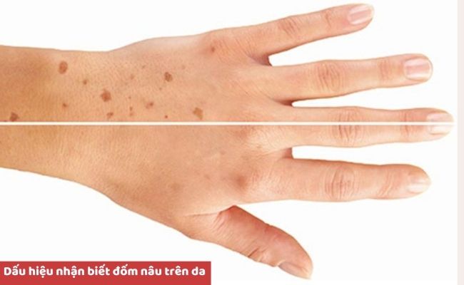 Dấu hiệu nhận biết đốm nâu trên da