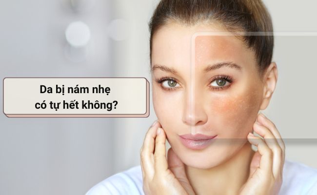 Da bị nám nhẹ có tự hết không?
