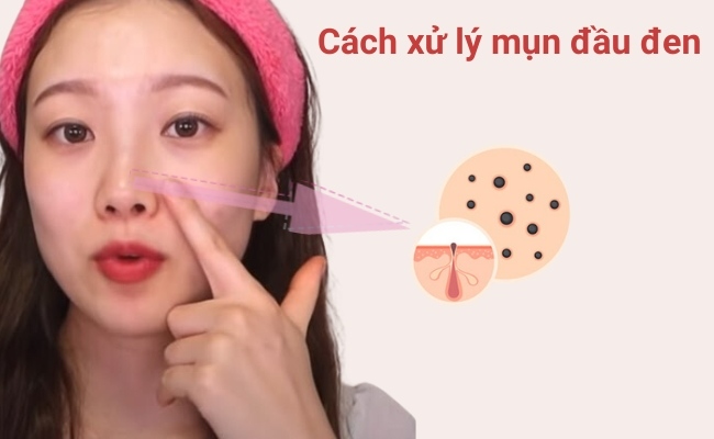 Cách xử lý mụn đầu đen