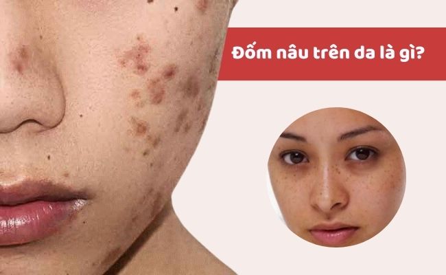 Đốm nâu trên da là gì?