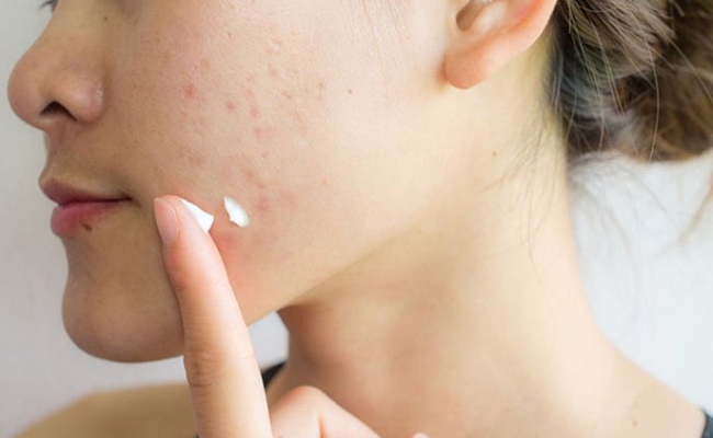 quy trình chăm sóc da mụn