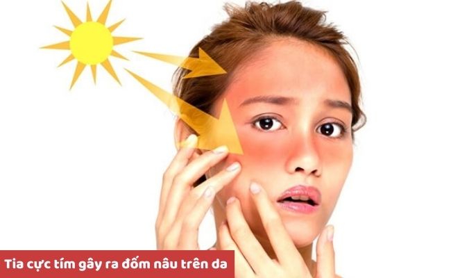 Nguyên nhân nổi đốm nâu
