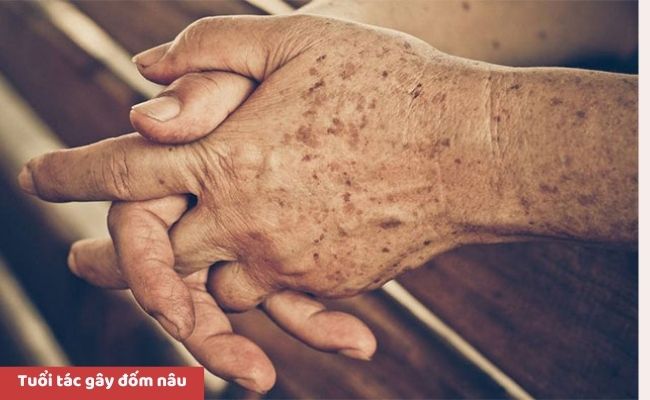 Nguyên nhân nổi đốm nâu