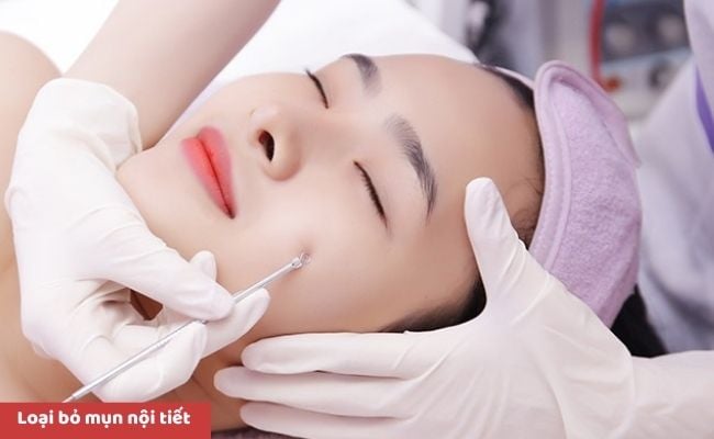 Cách điều trị mụn nội tiết hiệu quả
