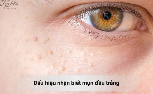 Mụn đầu trắng thường xuất hiện ở vị trí nào